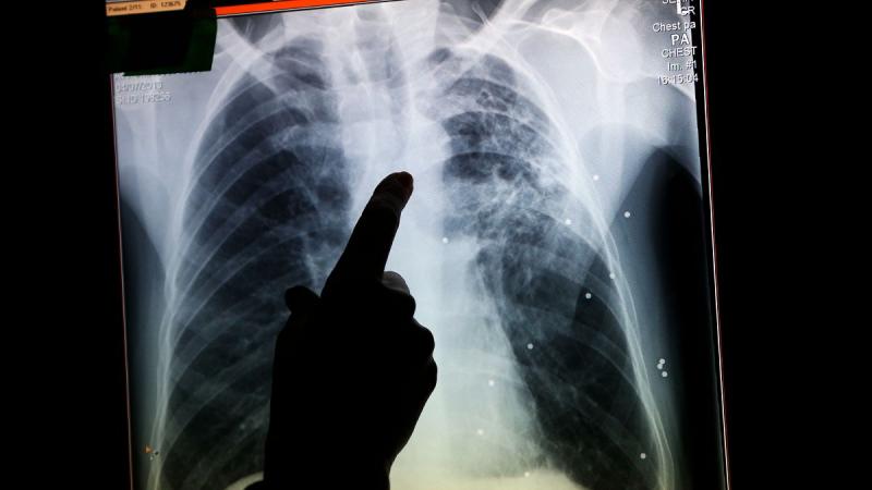 Miért terjed olyan ütemben a tuberkulózis az Egyesült Királyságban? Ennek a jelenségnek több összetevője is van, amelyek közrejátszanak a betegség gyors elterjedésében. Az urbanizáció, a sűrűn lakott területek, valamint a nem megfelelő egészségügyi ellátá